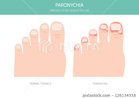 Paronychia Nail Infection. Medical Infographic Vector Illustration Paronychia Nail Infection. Medical Infographic Vector Illustration 126134358