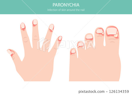 Paronychia Nail Infection. Medical Infographic Vector Illustration Paronychia Nail Infection. Medical Infographic Vector Illustration 126134359