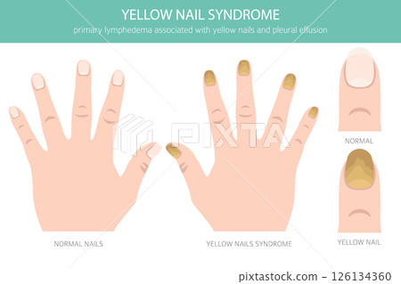 Yellow Nail Syndrome. Medical Infographic Vector Illustration 126134360