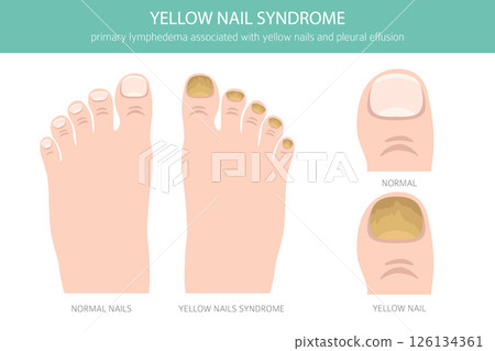 Yellow Nail Syndrome. Medical Infographic Vector Illustration 126134361