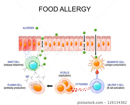 Food allergy. Process of allergic reaction and immune response 126134362