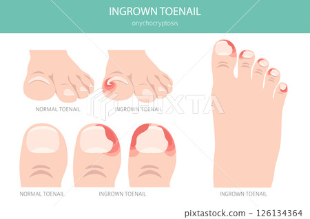 Ingrown Toenail (Onychocryptosis). Medical Infographic Vector Illustration 126134364