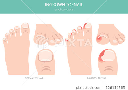Ingrown Toenail (Onychocryptosis). Medical Infographic Vector Illustration 126134365