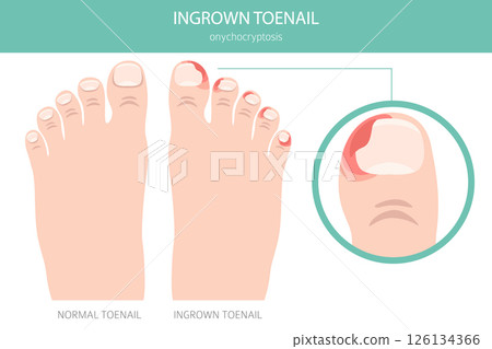 Ingrown Toenail (Onychocryptosis). Medical Infographic Vector Illustration 126134366
