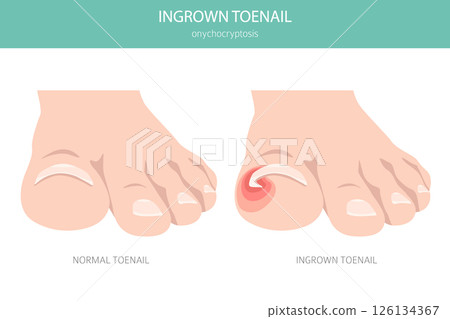 Ingrown Toenail (Onychocryptosis). Medical Infographic Vector Illustration Ingrown Toenail (Onychocryptosis). Medical Infographic Vector Illustration 126134367