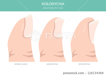 Koilonychia (Spoon Nails). Medical Infographic Vector Illustration 126134369