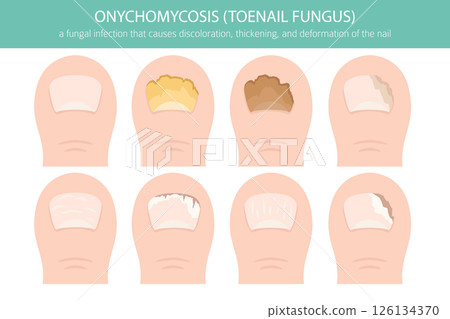 Onychomycosis Toenail Fungal Infection Vector Illustration 126134370