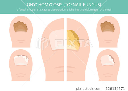 Onychomycosis Toenail Fungal Infection Vector Illustration 126134371