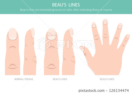 Beau's Lines. Medical Nail Disorder 126134474