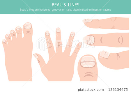 Beau's Lines. Medical Nail Disorder 126134475