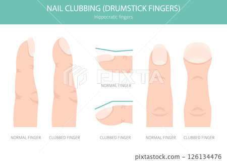 Digital Clubbing Nail Disease - Medical Infographic Vector Illustration 126134476