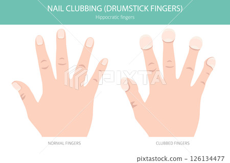 Digital Clubbing Nail Disease - Medical Infographic Vector Illustration Digital Clubbing Nail Disease - Medical Infographic Vector Illustration 126134477