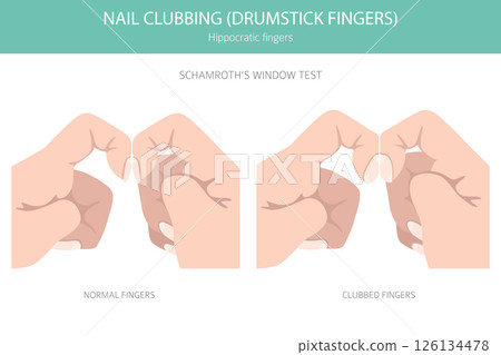 Digital Clubbing Nail Disease - Medical Infographic Vector Illustration 126134478