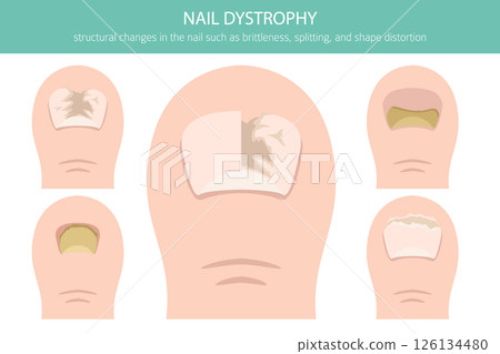 Nail dystrophy. Nail diseases. Medical infographic design 126134480