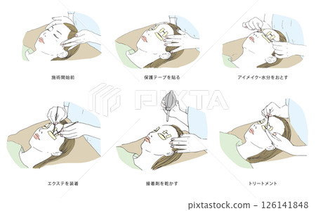 睫毛嫁接睫毛治療流程 睫毛嫁接睫毛治療流程 126141848