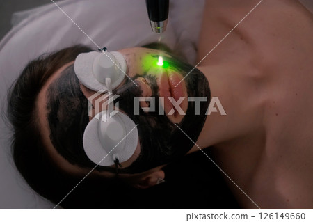 A woman is undergoing a carbon laser facial treatment. Her face is covered with a black carbon mask, protective goggles shield her eyes. 126149660