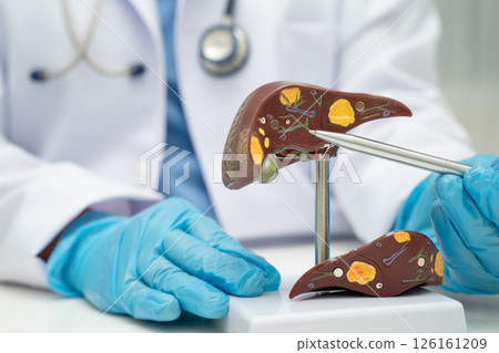 Cirrhosis, Liver cancer, fatty liver, Asian doctor with liver human anatomy model in World Hepatitis Day at hospital. 126161209