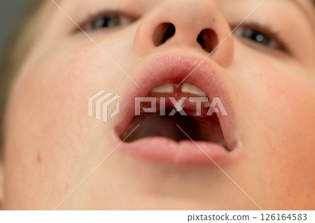 An incomplete tooth grows out of the palate. A close-up of a child's open mouth An incomplete tooth grows out of the palate. A close-up of a child's open mouth 126164583