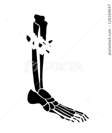 Vector isolated illustration of an open fracture of the tibia. X-ray of the leg. 126169647