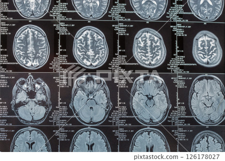 Magnetic resonance imaging or MRI image of the brain 126178027