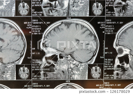 Magnetic resonance imaging or MRI image of the brain 126178029