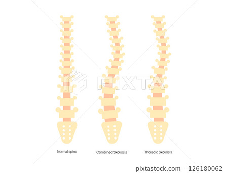 Scoliosis medical poster 126180062