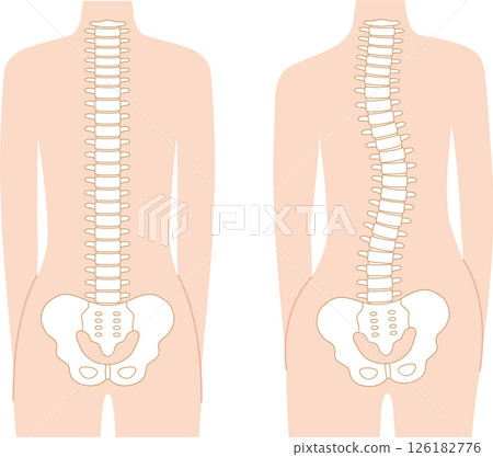 Spinal distortion Normal spine Spinal distortion Normal spine 126182776