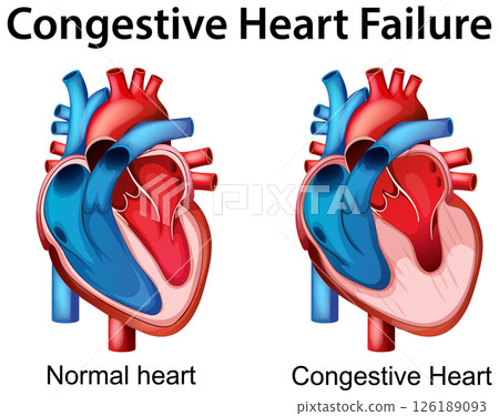 Comparison of Normal and Congestive Heart Illustration 126189093