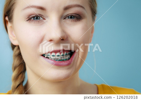 Closeup of woman teeth with braces, funny face Closeup of woman teeth with braces, funny face 126202018