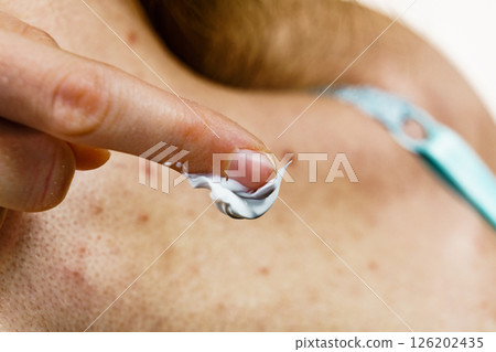 Woman with pimple on back applying medical ointmeny 126202435