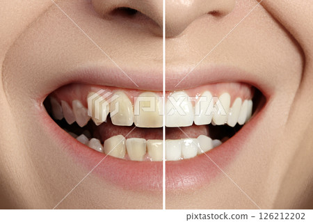 Woman Teeth Before and After Whitening. Perfect Smile with Healthy Teeth. Dental Clinic Patient. Oral Care Dentistry 126212202