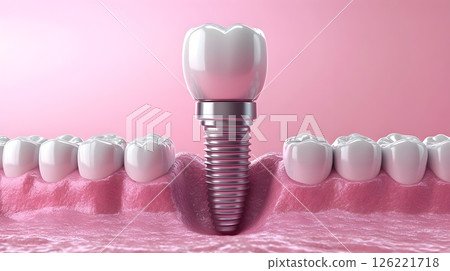 Dental implant with perfect teeth arrangement on a pink background 126221718