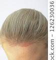 Cropped Caucasian Female Face with Sunburn Skin On Scalp, Forehead Under Hair, White Background. White Woman Suffers From Face Sun Burn. UV Danger. Vertical Plane 126230036