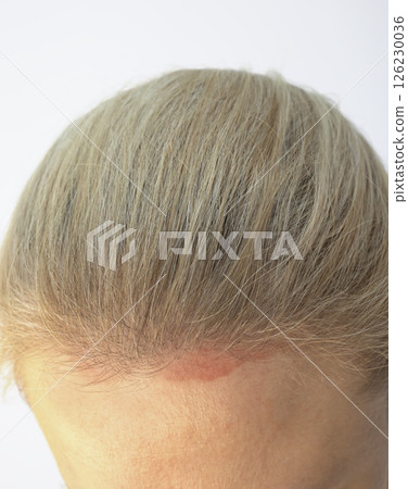 Cropped Caucasian Female Face with Sunburn Skin On Scalp, Forehead Under Hair, White Background. White Woman Suffers From Face Sun Burn. UV Danger. Vertical Plane 126230036