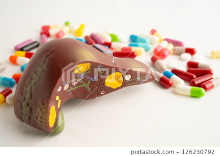 Liver model with pill drug treatment, Cirrhosis, Liver cancer, fatty liver. Liver model with pill drug treatment, Cirrhosis, Liver cancer, fatty liver. 126230792