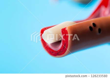 Female suppository with antibiotic and hormone in medical model of female reproductive system on blue background. Vaginal dysbacteriosis treatment concept. Copy space for text, antifungal 126233580