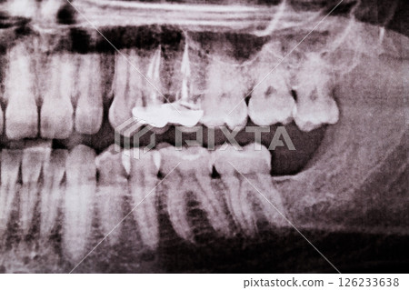 metal-ceramic crowns with filled dental canals on an x-ray image, close-up 126233638