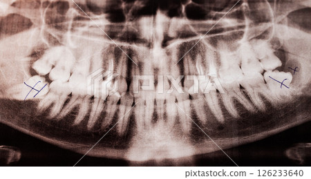 Dental jaw with crossed out Russian wisdom teeth and a purulent cyst on an x-ray image, close-up 126233640