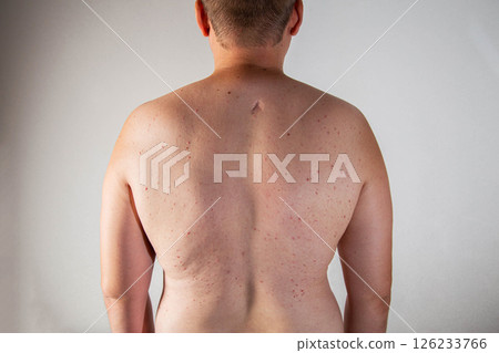 Red pimples on a man's back. Skin irritation and allergy concept. Diseases of the gastrointestinal tract, close-up Red pimples on a man's back. Skin irritation and allergy concept. Diseases of the gastrointestinal tract, close-up 126233766