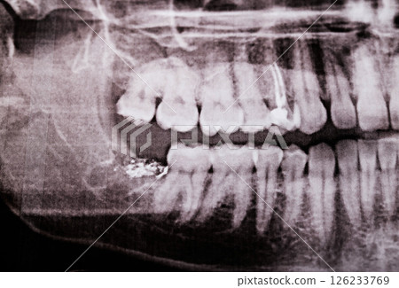 Empty tooth socket with medicine after wisdom tooth removal on x-ray, close-up 126233769