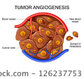 Tumor angiogenesis. Cancer cell development and metastasis 126237753