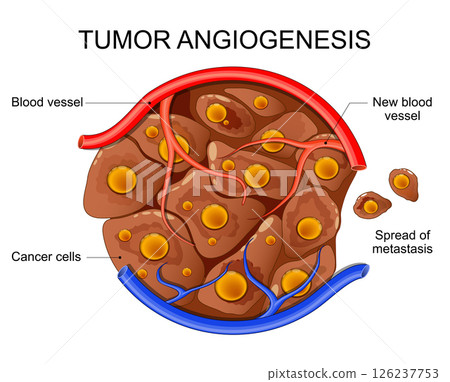 Tumor angiogenesis. Cancer cell development and metastasis Tumor angiogenesis. Cancer cell development and metastasis 126237753