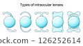 Types of intraocular lenses in Cataract surgery. 126252614