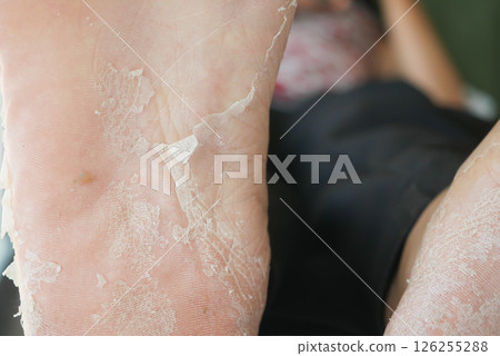 Dry, peeling foot skin during treatment Dry, peeling foot skin during treatment 126255288