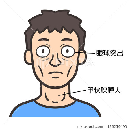 一名患有格雷夫茲病的男子的臉部 一名患有格雷夫茲病的男子的臉部 126259493