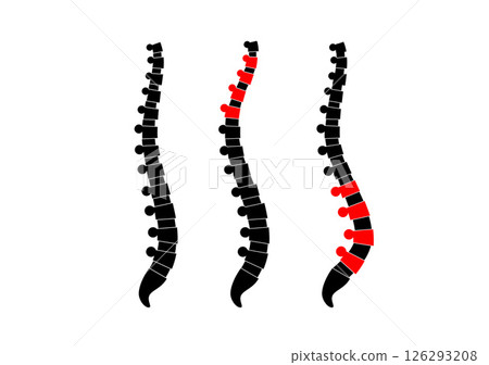 Scoliosis medical poster 126293208