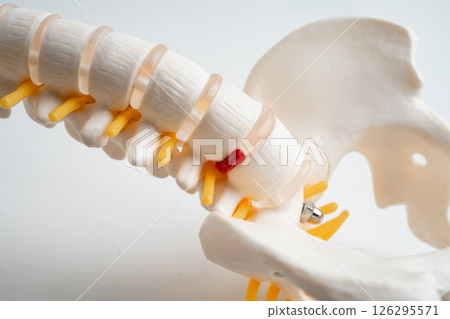 Lumbar spine displaced herniated disc fragment, spinal nerve and bone. Model for treatment medical in the orthopedic department. 126295571