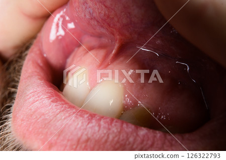 Close-up of open mouth showing teeth, gums, and tongue. Close-up of open mouth showing teeth, gums, and tongue. 126322793