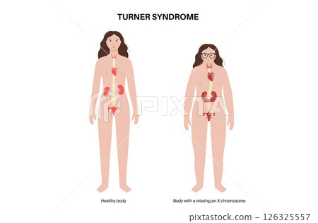 Turner syndrome poster Turner syndrome poster 126325557