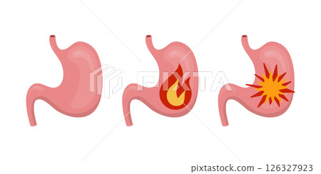Stomach with heartburn and stomach ulcer on white background 126327923